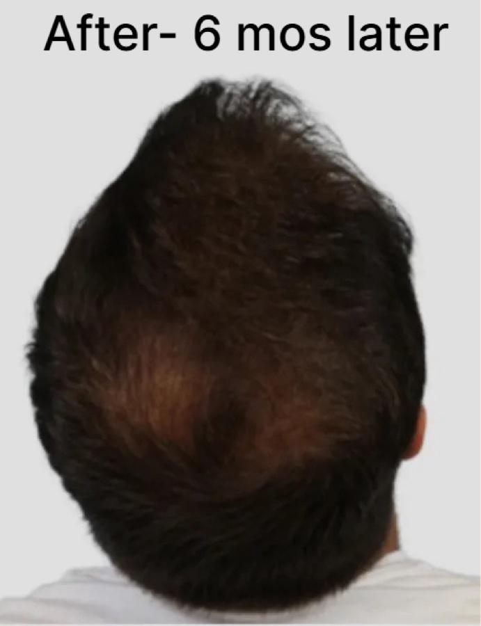 The same man's head six months later, with visibly denser coverage through the crown