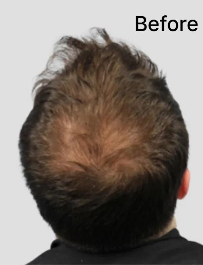 Back of a man's head before treatment, showing thinning through the crown
